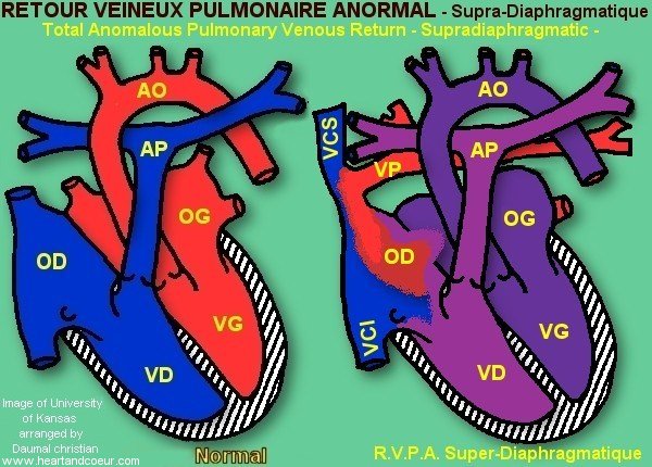 Retour Veineux pulmonaire supradiaphragmatique - Total Anomalous Pulmonary Venous Return supradiaphragmatic