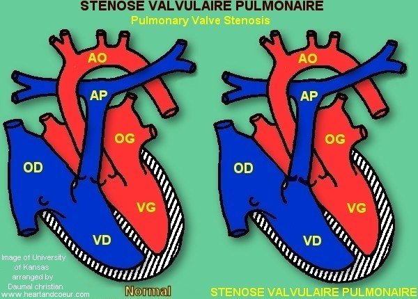 Stnose valvulaire pulmonaire - Pulmonary Valve Stenosis