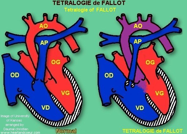 Ttralogie de Fallot - Tetralogie of Fallot