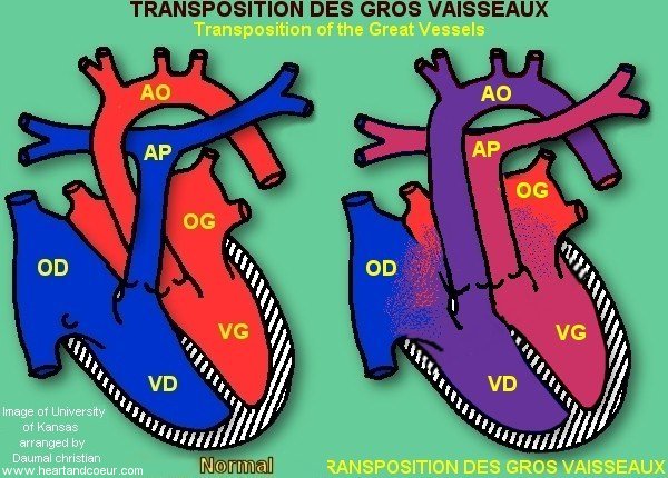 Transposition des gros vaisseaux - TGV - Transposition of the Great Vessels -TVG