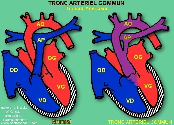 Tronc Artriel Commun - Truncus Arteriosus