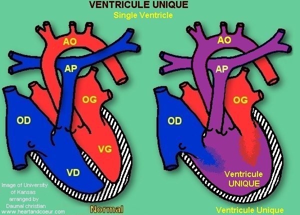 Ventricule unique - Single Ventricle 